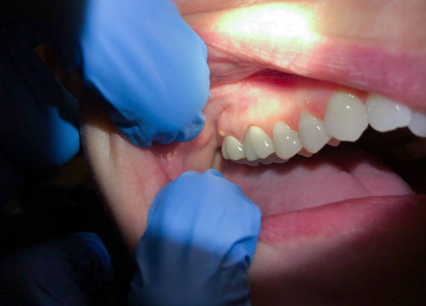 Best Broken or Cracked Tooth Emergency Dentist in Bessemer, AL