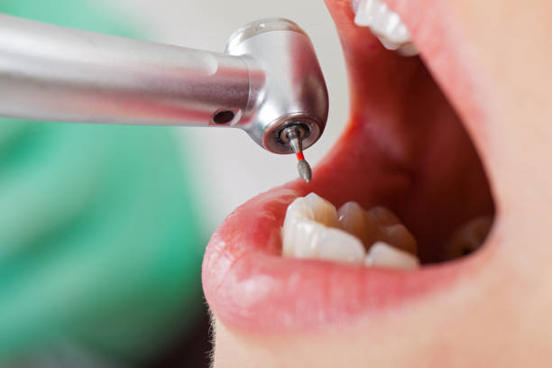 Best Emergency Dentist for Lost Fillings or Crowns in Bessemer, AL